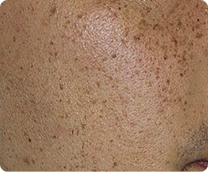bikini_hair_reduction_dr_blaha 10 bikini_hair_reduction_dr_blaha 10
