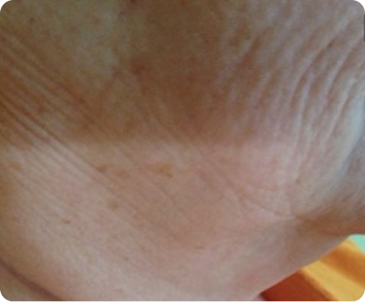bikini_hair_reduction_dr_blaha 14 bikini_hair_reduction_dr_blaha 14