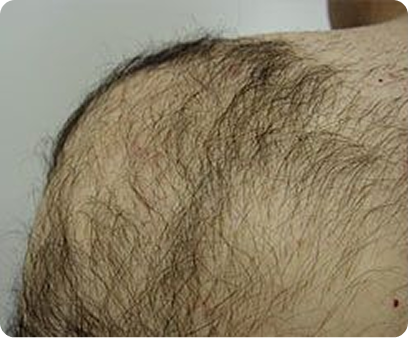shoulder_hair_reduction_sult_rn 2 shoulder_hair_reduction_sult_rn 2